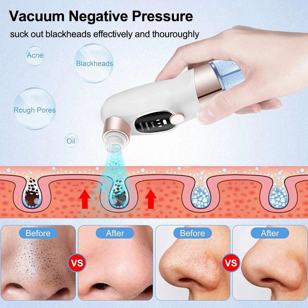 Blackhead Remover Vacuum – Deep Pore Face Cleaner