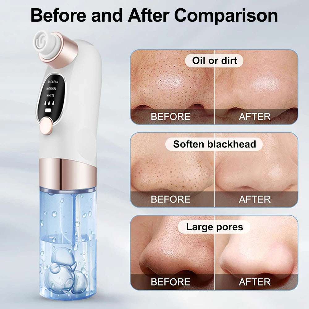 Blackhead Remover Vacuum – Deep Pore Face Cleaner